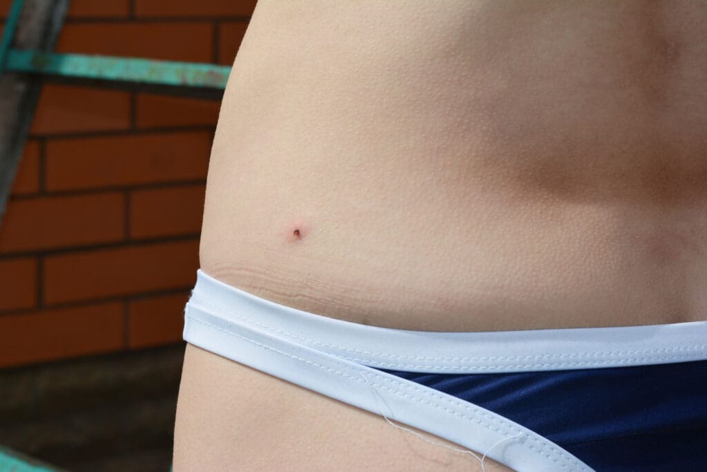 Small tick attached to human skin near the waistline in southern Maine